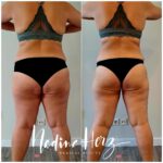 Rückenansicht im Verlauf eines individuell begleiteten Abnehmprogramms