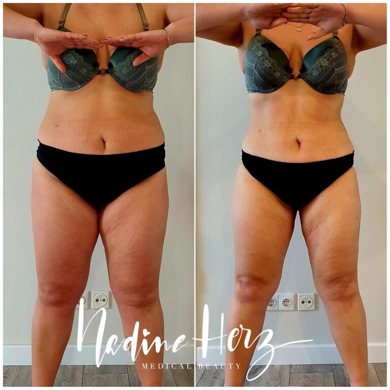 Ansicht von vorn im Verlauf eines individuell begleiteten Abnehmprogramms