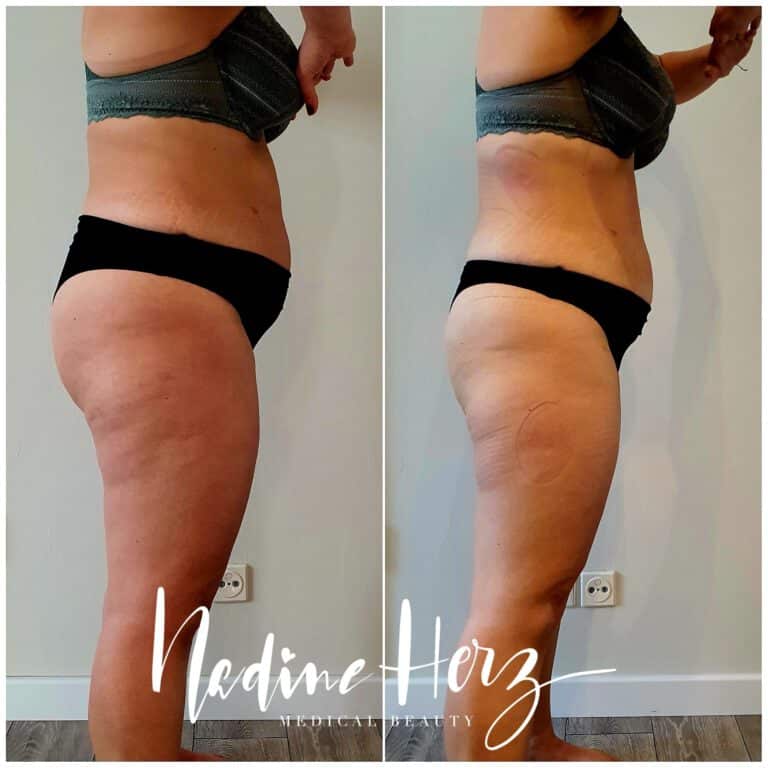 Ansicht von der Seite im Verlauf eines individuell begleiteten Abnehmprogramms