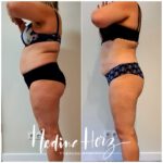 Seitenansicht bei einer Gewichtsreduktion