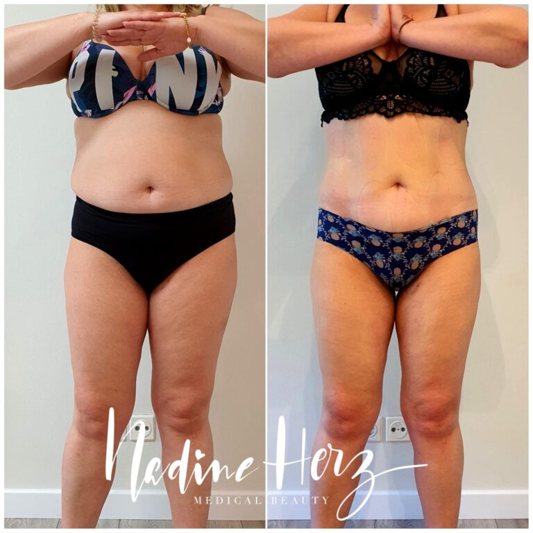 Vorderansicht im Verlauf eines ganzheitlichen Abnehmprogramms