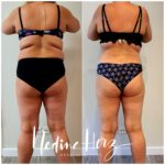 Rückenansicht im Verlauf eines Programms zur begleitenden Gewichtsreduktion