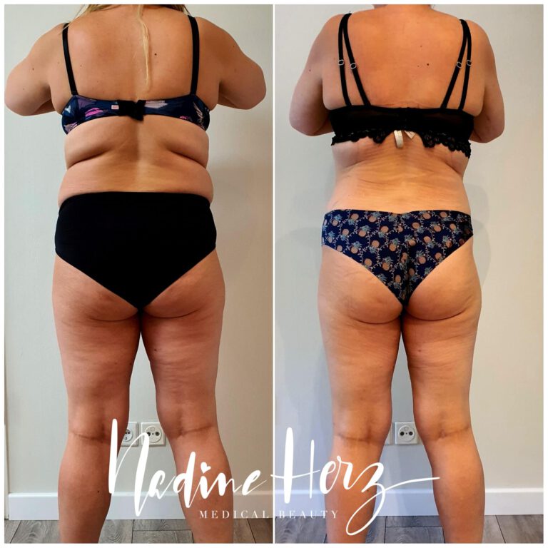 Rückenansicht im Verlauf eines Programms zur begleitenden Gewichtsreduktion